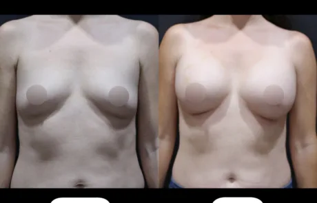 Breast augmentation before and after in Korea using Mentor smooth round implants 400cc moderate plus profile, dual plane technique for post-pregnancy breast volume restoration