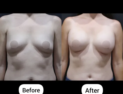 Post-Pregnancy Breast Volume Restoration with 400cc Mentor Implants | Breast Augmentation Before & After