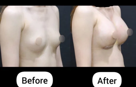 Breast augmentation before and after side view using Mentor smooth round moderate plus 350cc implants at Evita Clinic Korea