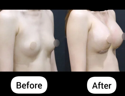 Breast Augmentation with Mentor Smooth Round Moderate Plus 350cc