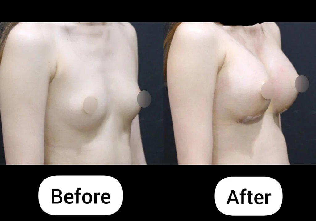 Breast augmentation before and after side view using Mentor smooth round moderate plus 350cc implants at Evita Clinic Korea