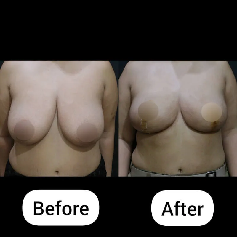 breast-lift-before-after-front-korea Breast lift before and after using anchor mastopexy with superomedial pedicle showing improved breast position and shape