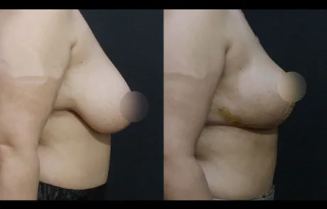 breast lift side before after korea