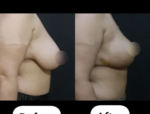 Breast Lift (Anchor Mastopexy) with Superomedial Pedicle