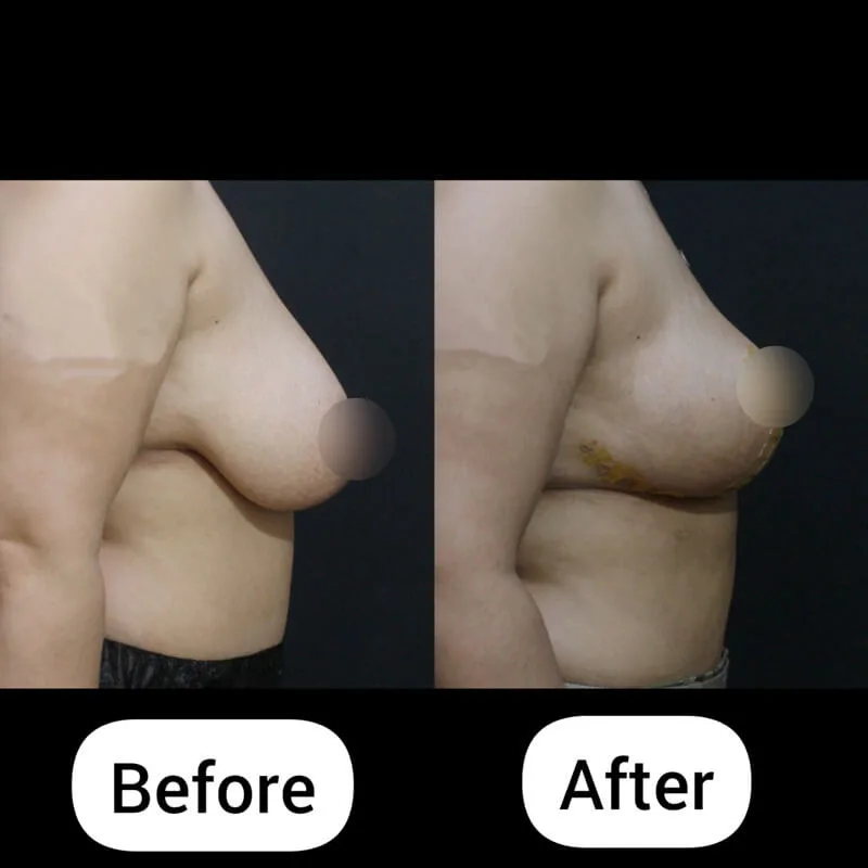 breast lift side before after korea