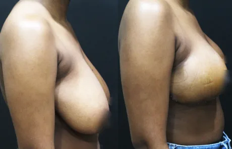 anchor mastopexy breast lift before and after side view sagging breast correction Korea