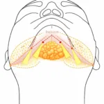 chin-accusculpt-laser-liposuction-treatment-area Diagram showing chin Accusculpt laser liposuction treatment area from under the chin to the jawline near the ears