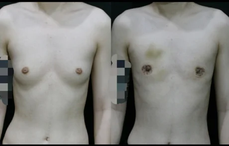 FTM top surgery before and 2 weeks after keyhole technique showing minimal scars and early healing stage