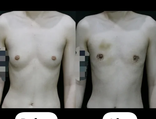 FTM Top Surgery (Keyhole Technique) – 2 Weeks After Surgery