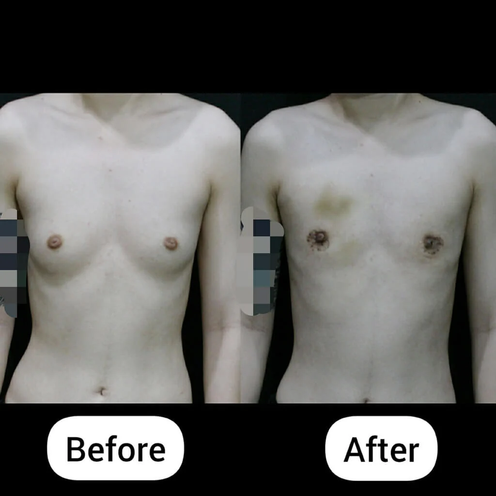 FTM top surgery before and 2 weeks after keyhole technique showing minimal scars and early healing stage