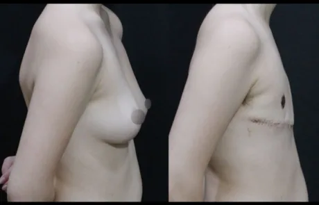FTM top surgery before and after double incision mastectomy with free nipple graft at 2 weeks postoperative
