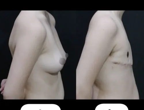 Gender-Affirming Mastectomy (FTM Top Surgery)  Double Incision with Free Nipple Graft – 2 Weeks Postoperative