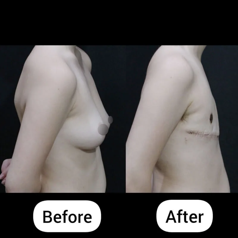 FTM top surgery before and after double incision mastectomy with free nipple graft at 2 weeks postoperative