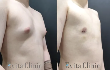Oblique view of a teenage gynecomastia patient before and after surgery showing reduced nipple projection and flatter chest.
