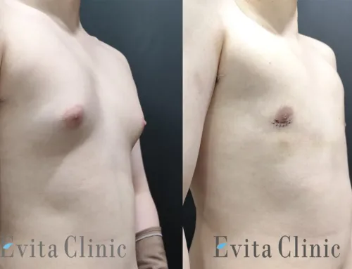 Adolescent Gynecomastia Surgery (Age 16) – Grade II Gynecomastia