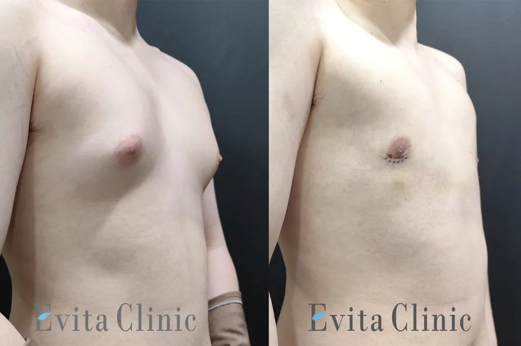 gynecomastia-teen-16-before-oblique Oblique view of a teenage gynecomastia patient before and after surgery showing reduced nipple projection and flatter chest.