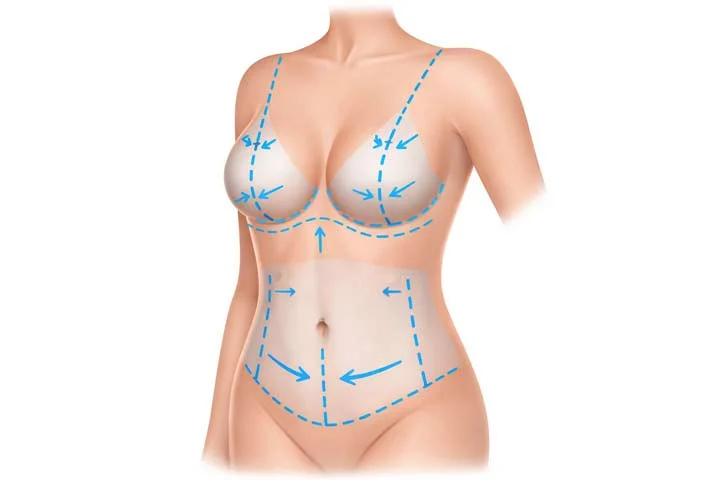 Mommy Makeover illustration showing abdominal contouring and breast reshaping after pregnancy