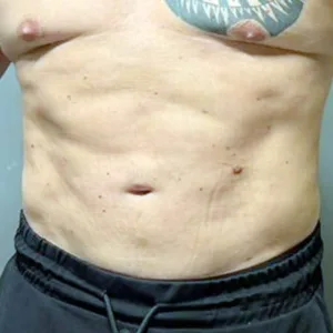 Male abdominal liposuction 1 month result showing flatter abdomen and visible six-pack definition