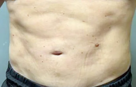 Male abdominal liposuction 1 month result showing flatter abdomen and visible six-pack definition