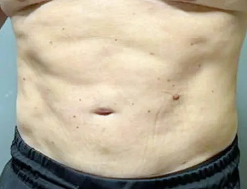 Abdominal Liposuction 1 Month Result – From Protruding Belly to Visible Six-Pack