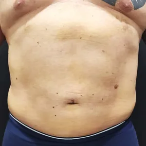 Tummy_Liposuction_202604_1week Tummy Liposuction 202604 1week