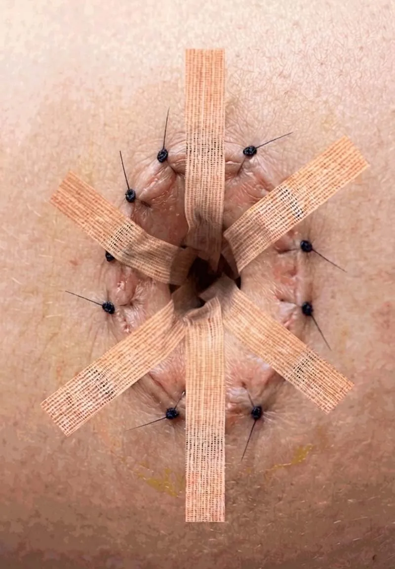 Steri-Strips around the belly button after abdominoplasty