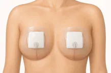 Negative Pressure Wound Therapy dressing after breast reduction surgery