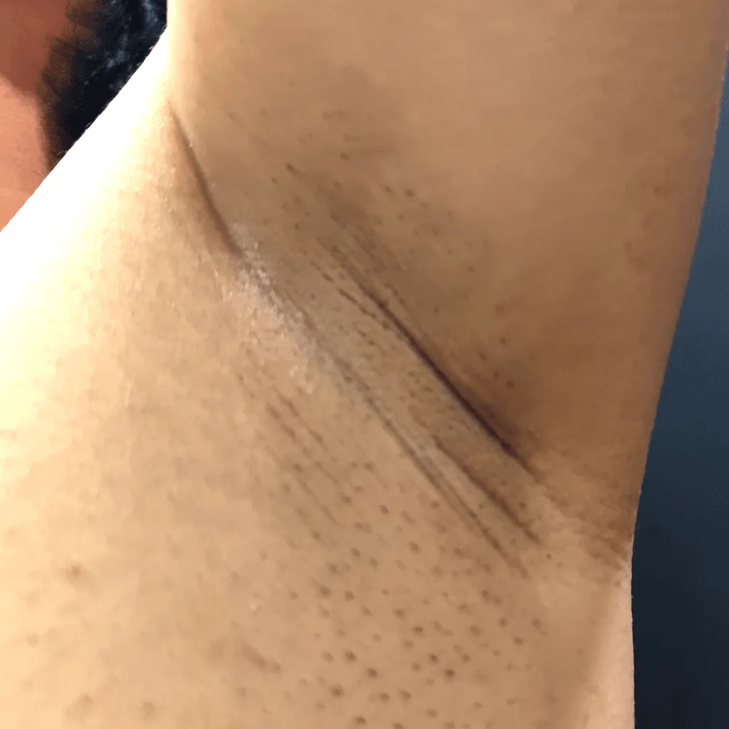 Underarm before osmidrosis surgery, showing the natural axillary crease where the incision is placed.