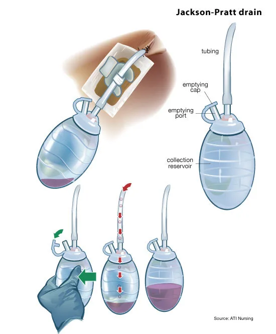 How to empty a Jackson-Pratt surgical drain