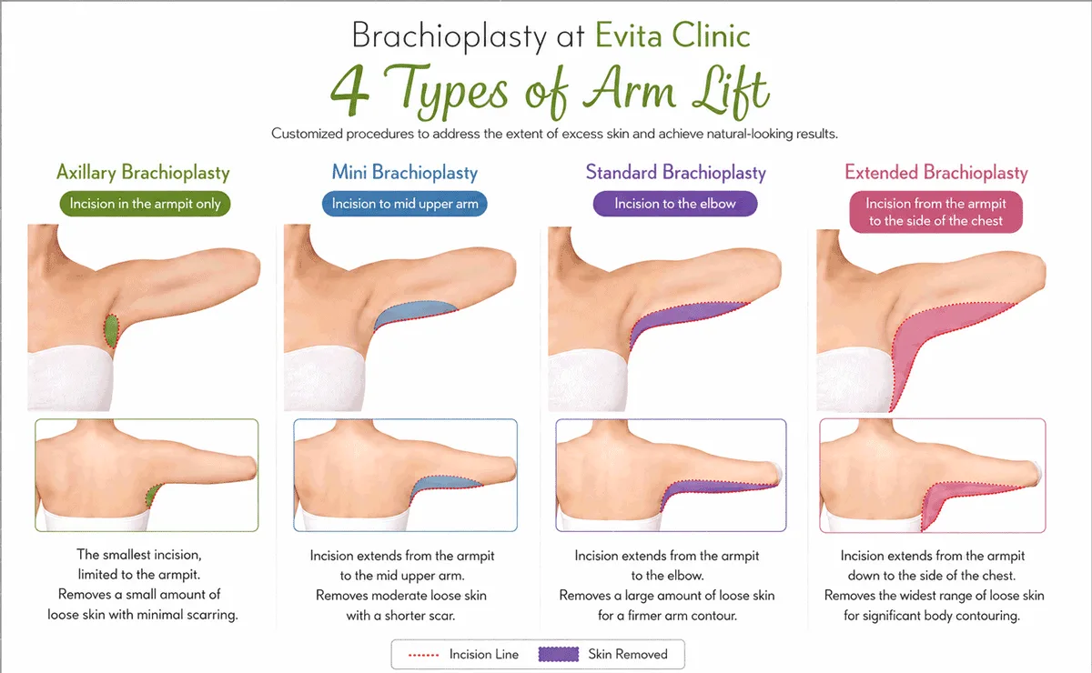 Four brachioplasty types showing axillary, mini, standard and extended upper-arm skin removal areas and incision lines