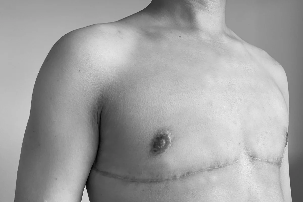 Chest contour after gender-affirming top surgery