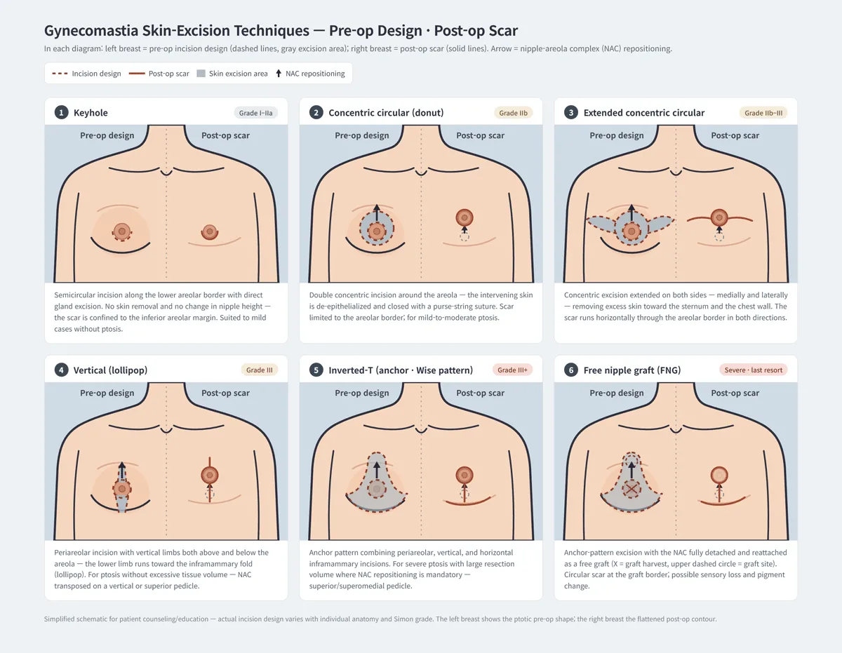 gynecomastia-surgical-techniques-incisions-scars Gynecomastia surgical techniques comparing preoperative incision designs, skin excision areas, nipple repositioning, and postoperative scars.