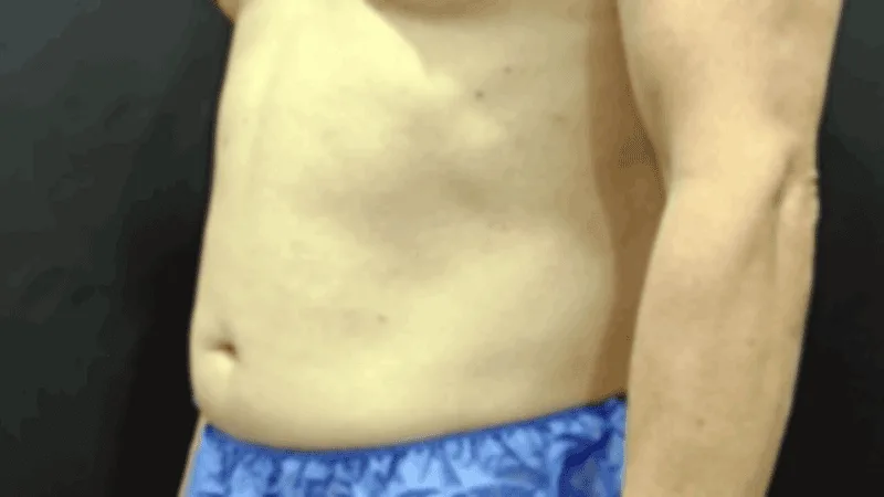 patient-lower-abdomen-side-profile-normal-bmi Side profile photo of a patient with normal BMI showing persistent lower abdominal fullness