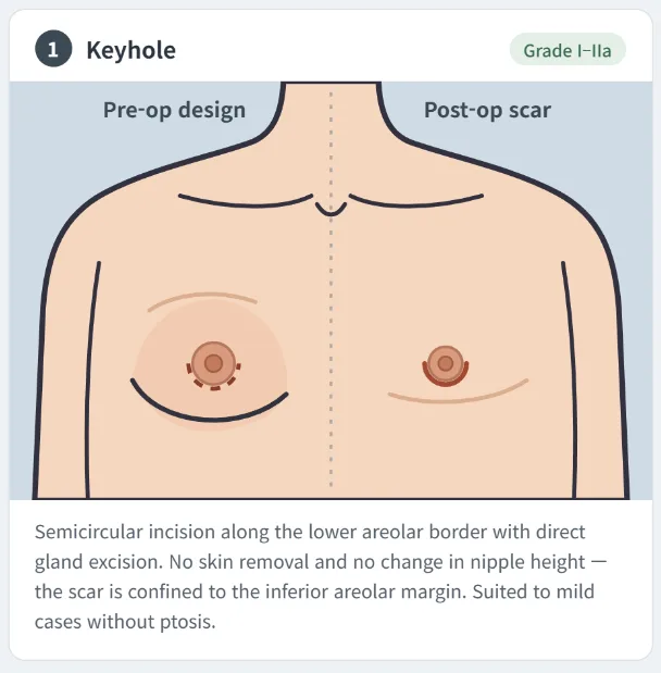 Keyhole gynecomastia surgery technique showing the preoperative incision design and postoperative scar