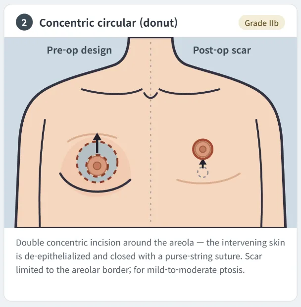 Concentric circular donut gynecomastia surgery technique showing periareolar skin excision and scar placement