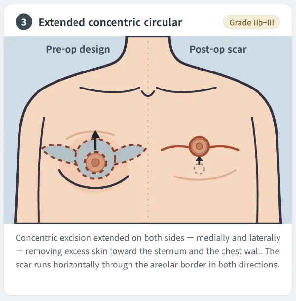 Extended concentric circular gynecomastia surgery technique showing wider medial and lateral skin excision
