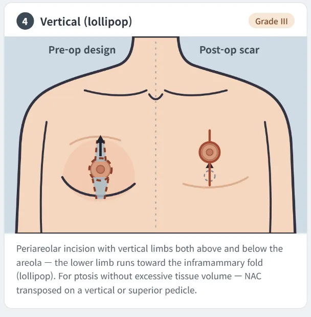 Vertical lollipop gynecomastia surgery technique showing periareolar and vertical scars