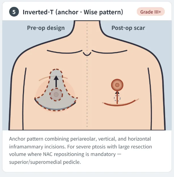 Inverted T anchor Wise pattern gynecomastia surgery technique showing periareolar vertical and horizontal scars