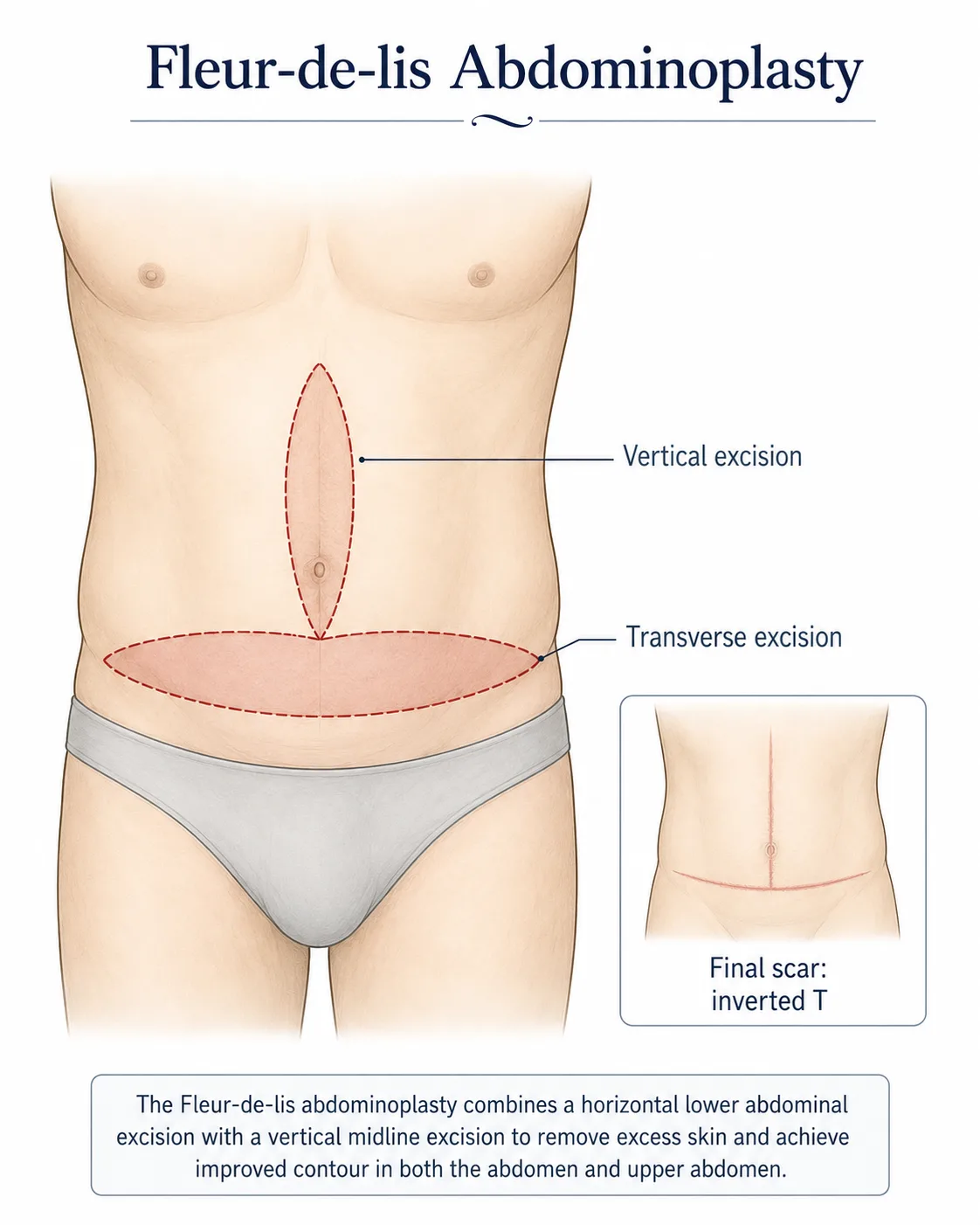 Illustration of fleur-de-lis abdominoplasty, showing horizontal and vertical skin excision and the resulting inverted-T scar