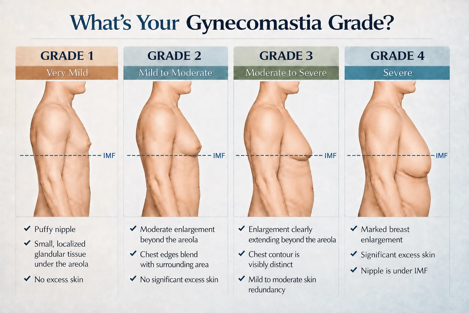 Gynecomastia grades 1 to 4 showing differences in chest enlargement, contour and skin redundancy