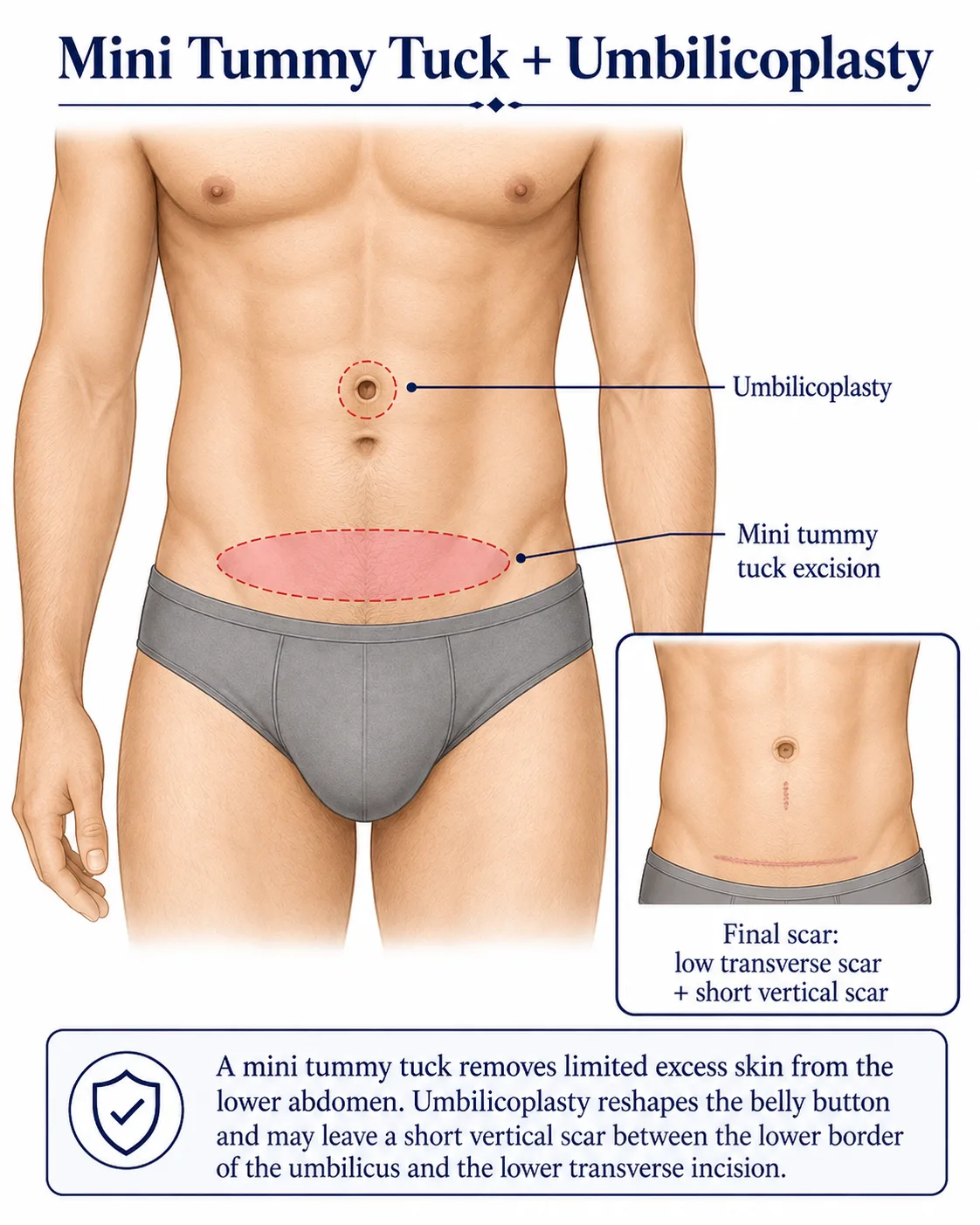 Illustration of a mini tummy tuck with umbilicoplasty, showing the lower abdominal excision and expected scars