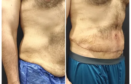 Tummy tuck before and after, oblique view, 2 weeks post-op – Evita Clinic Seoul