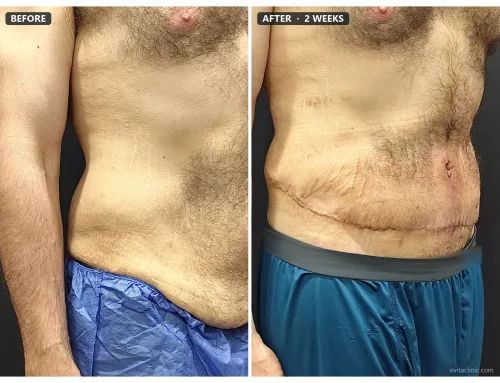 Lipoabdominoplasty (Tummy Tuck with 360° Liposuction) – 2 Weeks After Surgery