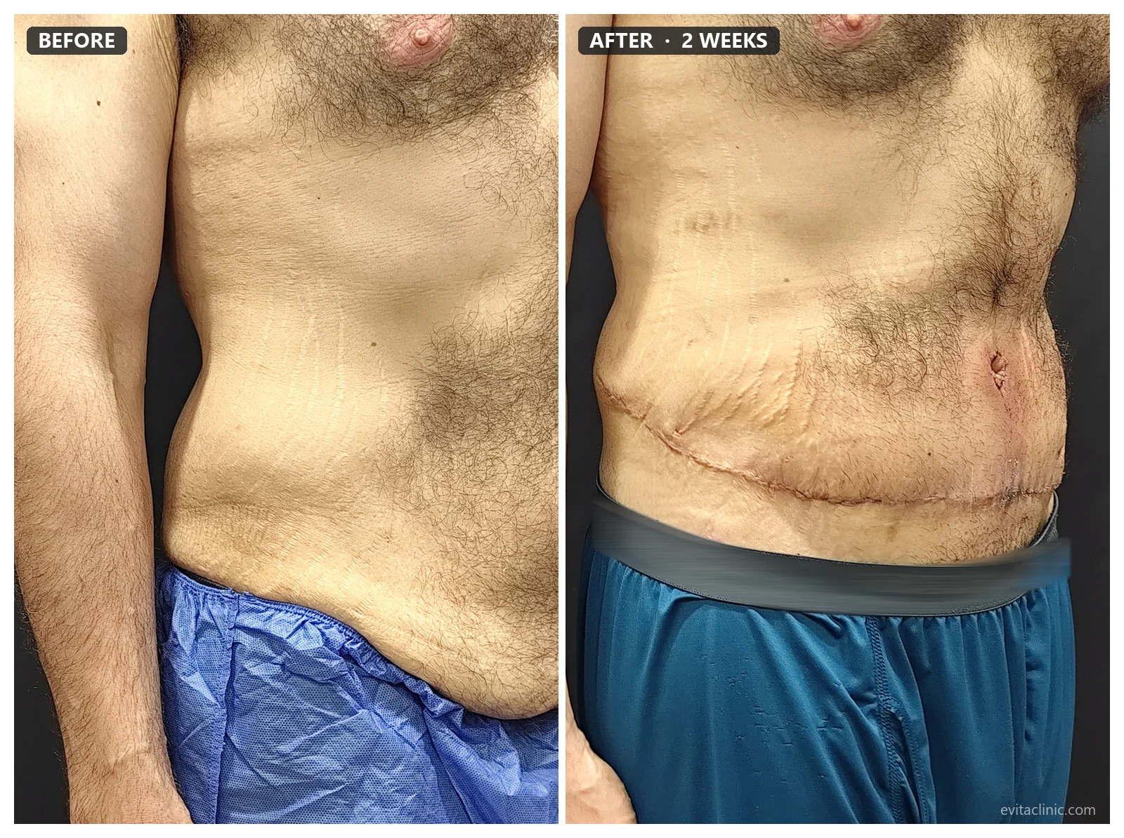 Tummy tuck before and after, oblique view, 2 weeks post-op – Evita Clinic Seoul