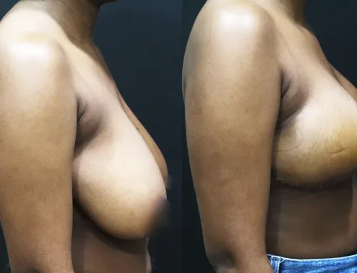 Breast Lift (Mastopexy) – Anchor Technique