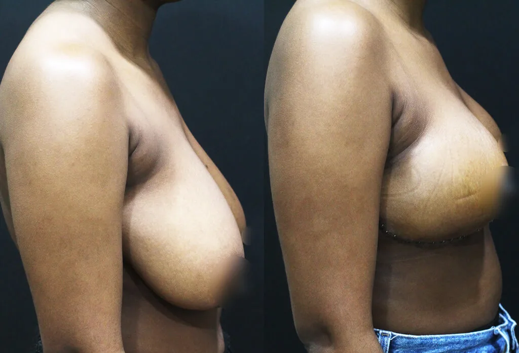 anchor mastopexy breast lift before and after side view sagging breast correction Korea