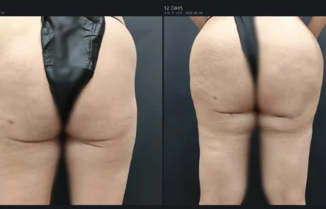 Brazilian butt lift fat grafting before and after, back view, 12 days post-op – Evita Clinic Seoul