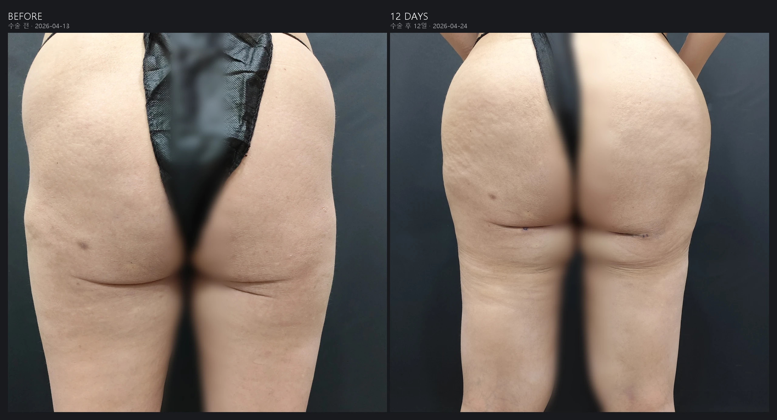Brazilian butt lift fat grafting before and after, back view, 12 days post-op – Evita Clinic Seoul