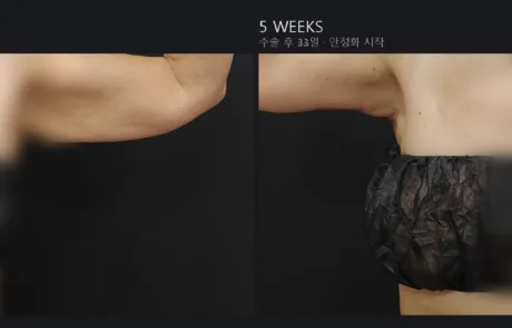 Arm lift brachioplasty before and after, front view, 5 weeks post-op – Evita Clinic Seoul
