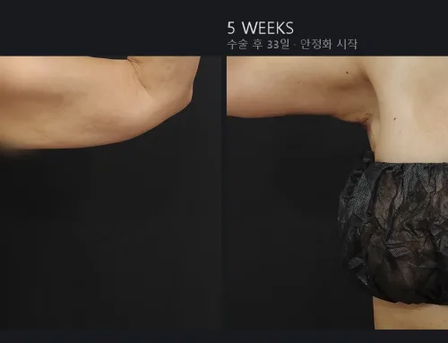 Arm Lift (Brachioplasty) – 5 Weeks After Surgery